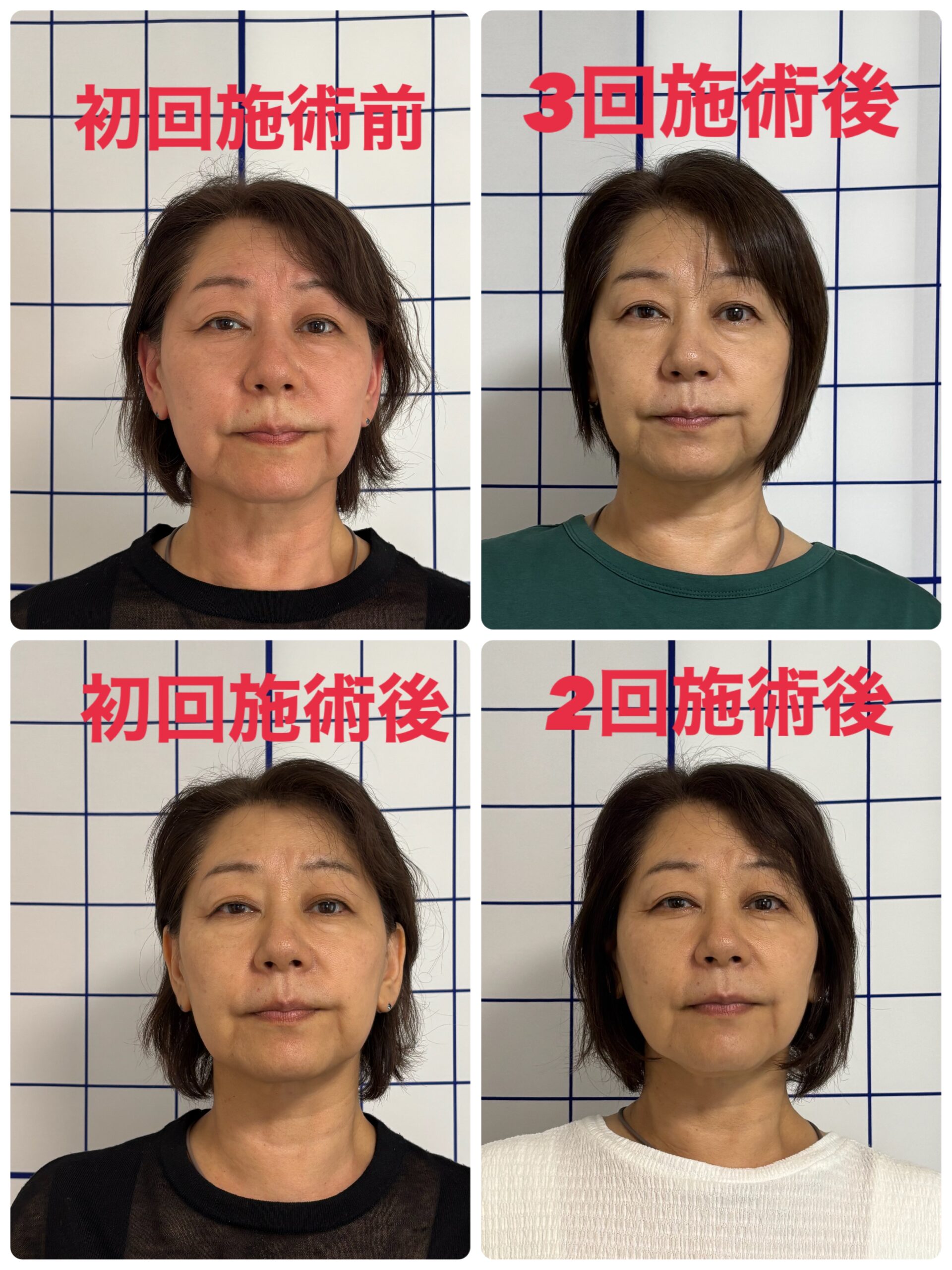 美容神経エステで笑顔